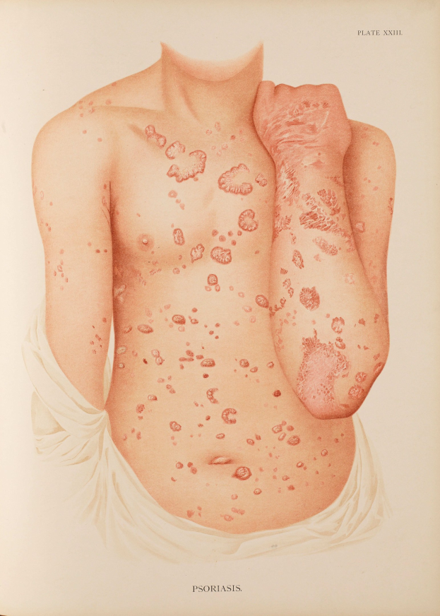 Ein Buchumschlag mit einer Illustration eines Männerkörpers mit roten Flecken, die likely Psoriasis anzeigen, zusammen mit Text über die Bedingung.
