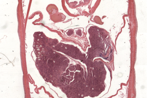 Ein Querschnitt eines menschlichen Herzens mit einer kleinen Menge Blut, der einen Histiozyten zeigt.