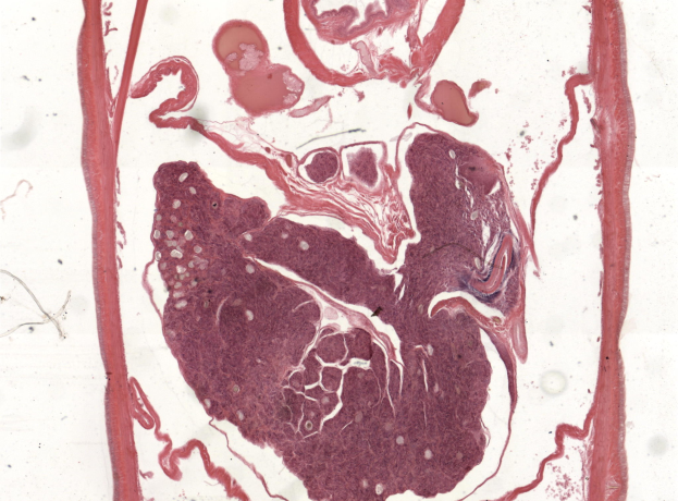 Ein Querschnitt eines menschlichen Herzens mit einer kleinen Menge Blut, der einen Histiozyten zeigt.